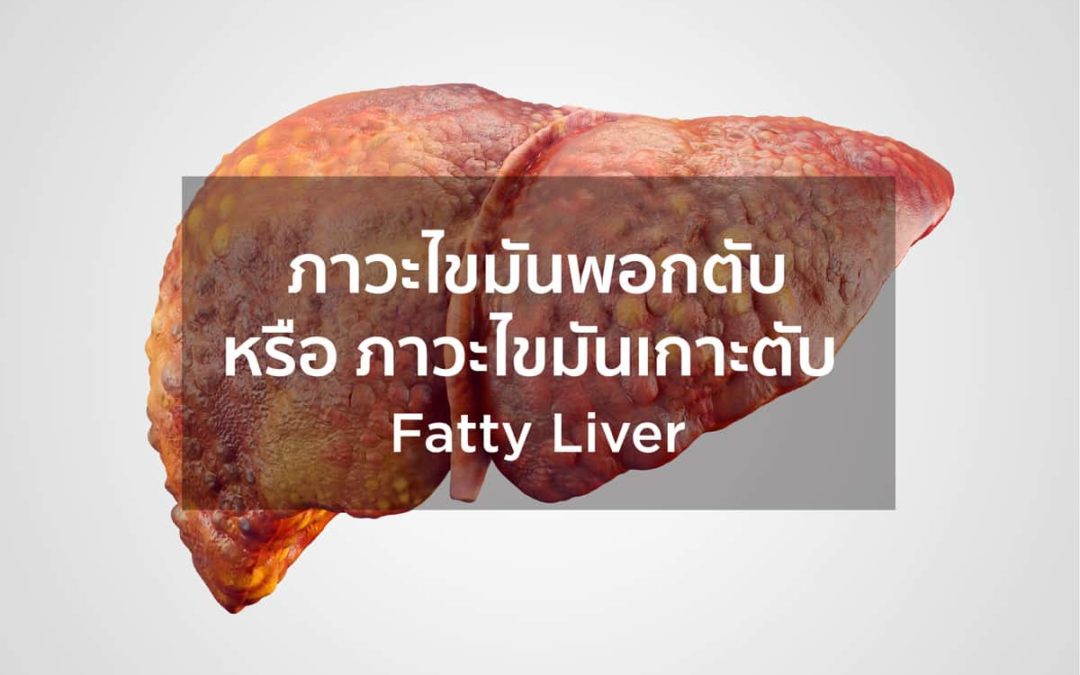 ภาวะไขมันเกาะตับ