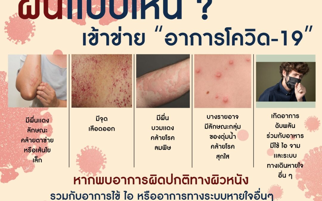 ผื่นแบบไหนเข้าข่ายโควิด