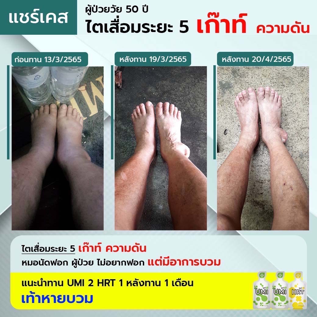 รีวิว ผลดีจากไตระยะ5 เก๊าท์